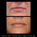 Photo of Filler Treatments