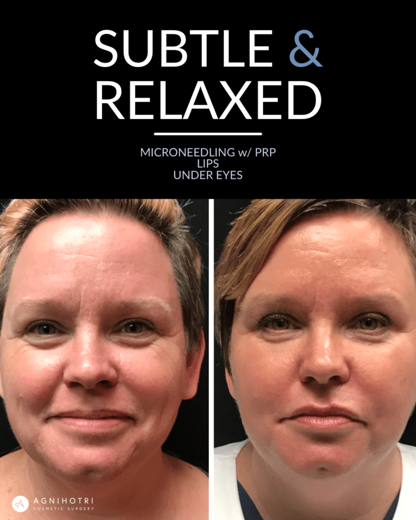 Photo of Filler Treatments