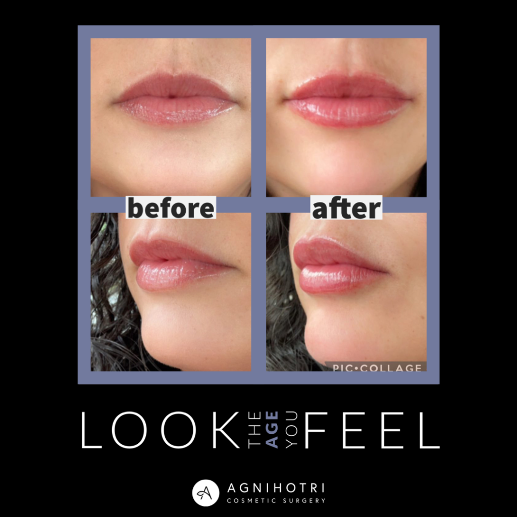 Photo of Filler Treatments