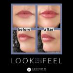 Photo of Filler Treatments