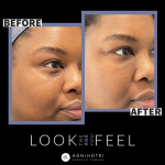 Photo of Filler Treatments