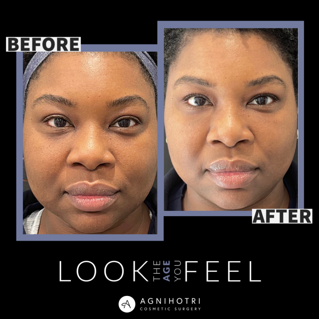 Photo of Filler Treatments