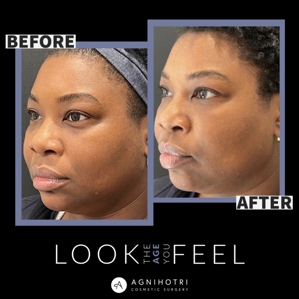 Photo of Filler Treatments