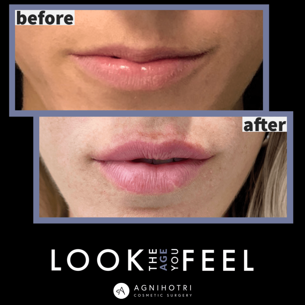 Photo of Filler Treatments