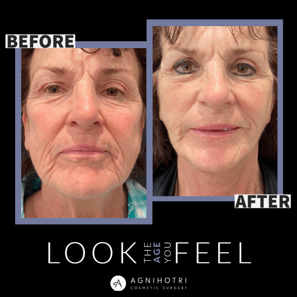 Photo of Face/Neck Lift