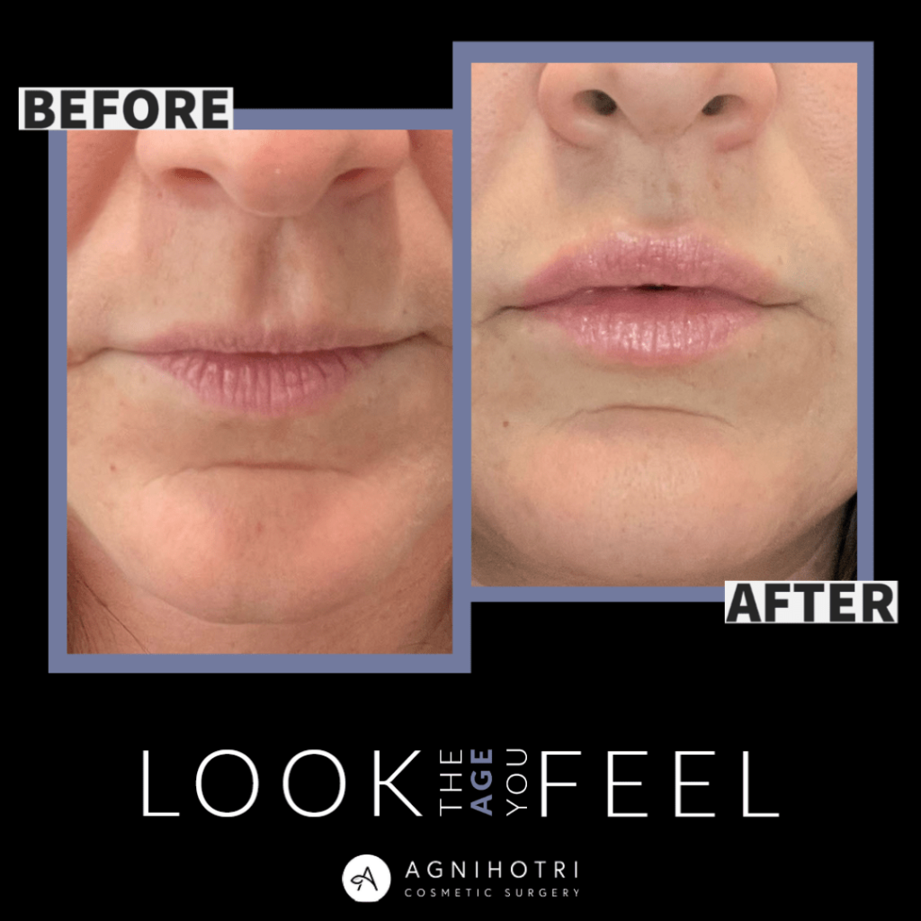 Photo of Filler Treatments