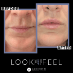 Photo of Filler Treatments