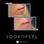 Photo of Filler Treatments