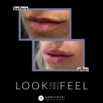 Photo of Filler Treatments