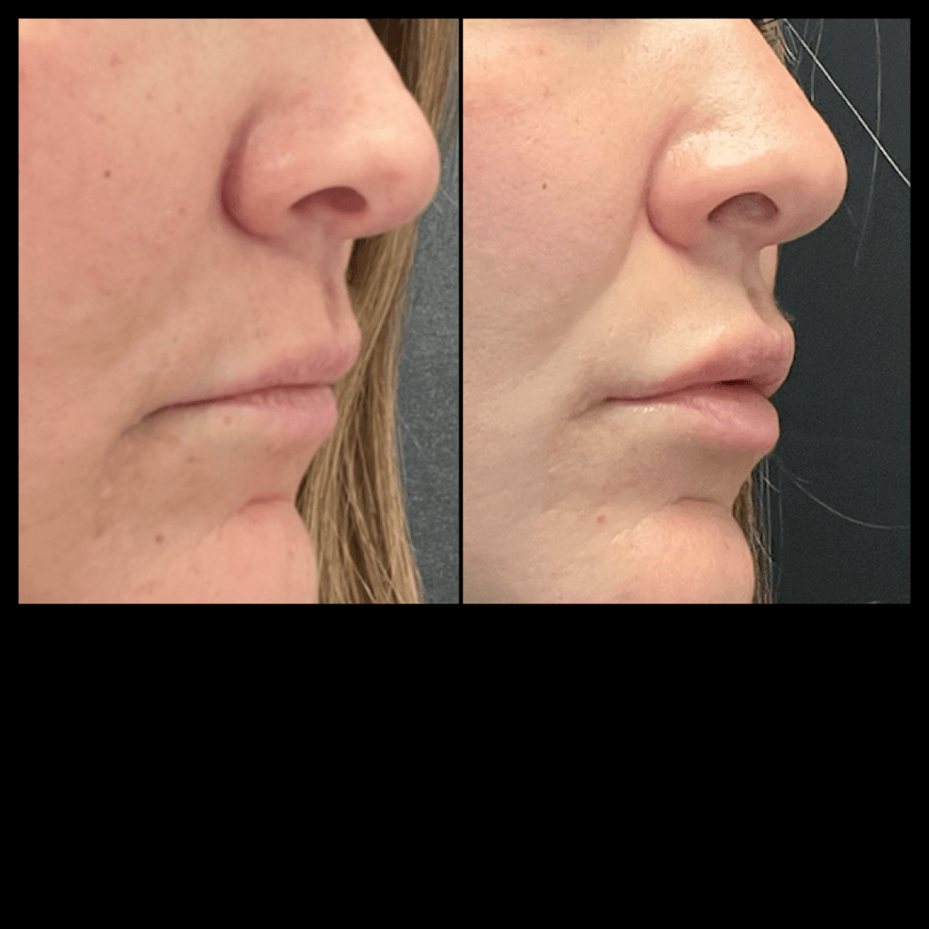 Photo of Filler Treatments