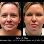 Photo of Filler Treatments