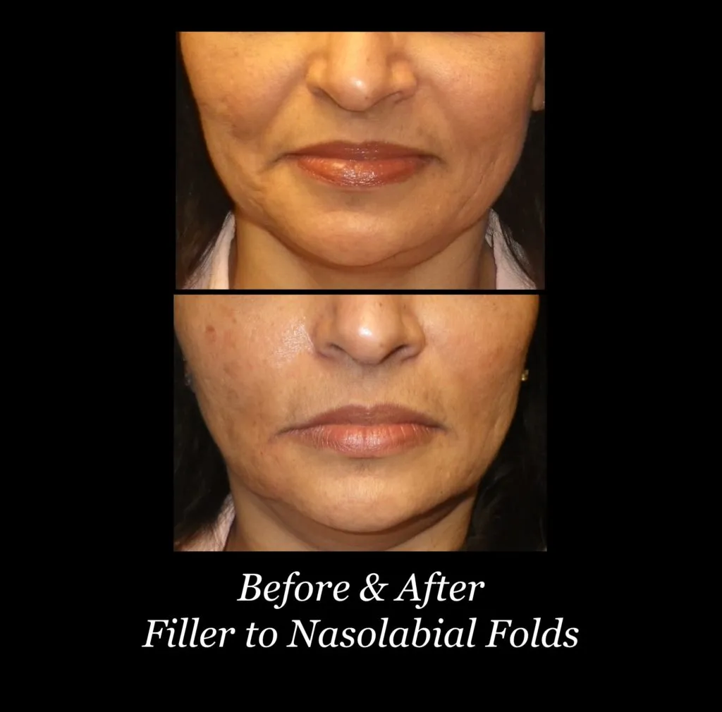 Photo of Filler Treatments