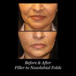 Photo of Filler Treatments