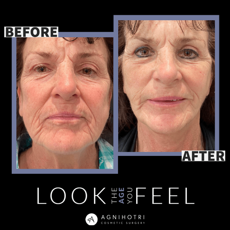 Face/Neck Lift & Contour before and after