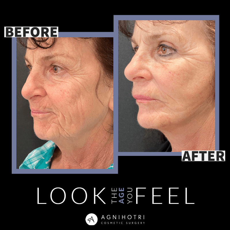 Fat transfer before and after