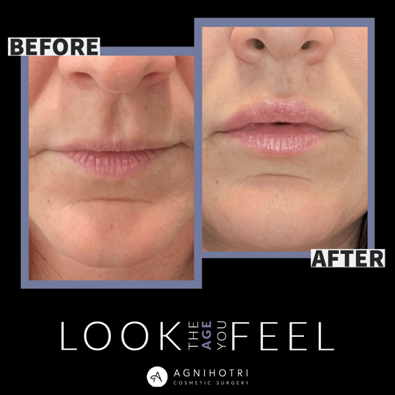 Lip filler before and after