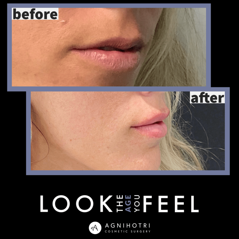 Lip filler before and after