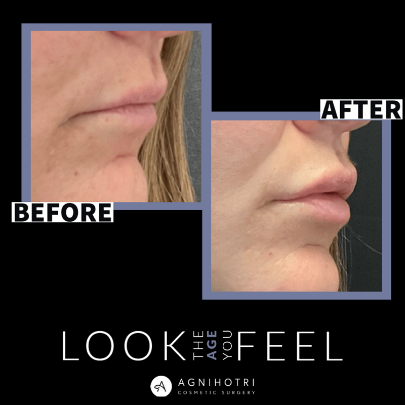 Lip filler before and after