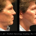 Photo of Face/Neck Lift