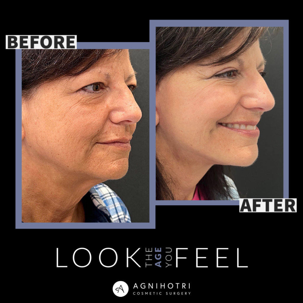 Photo of Face/Neck Lift