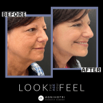 Photo of Face/Neck Lift
