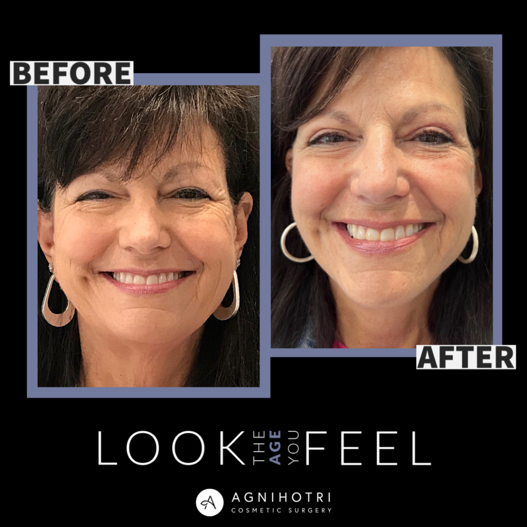 Photo of Face/Neck Lift
