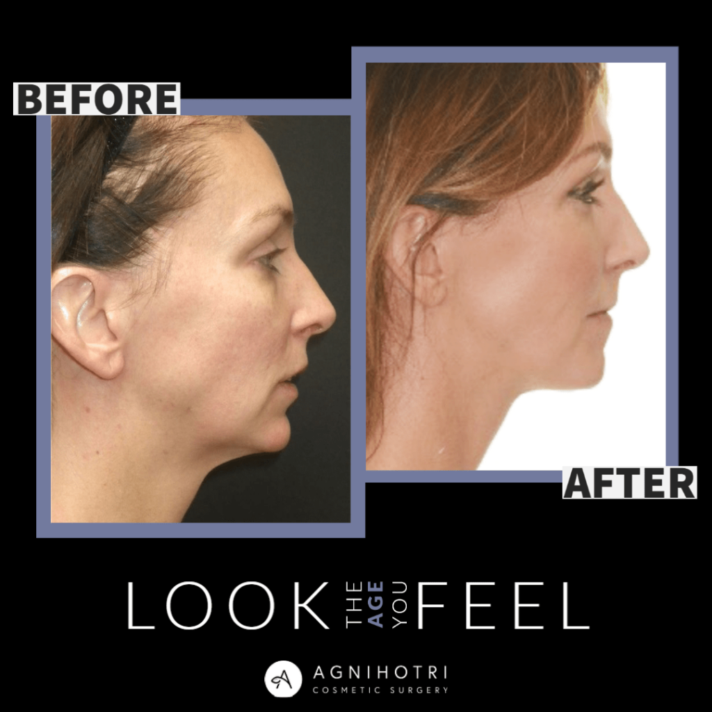 Photo of Face/Neck Lift