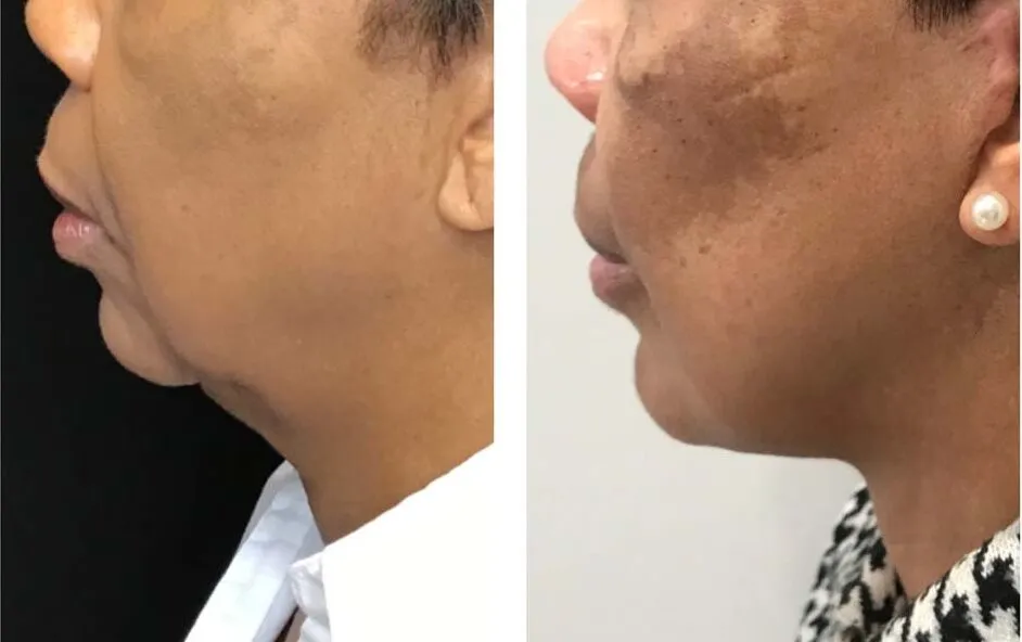 Photo of Face/Neck Lift