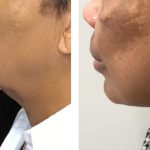 Photo of Face/Neck Lift