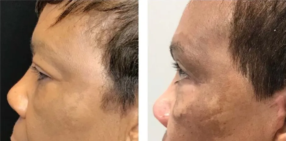 Photo of Face/Neck Lift