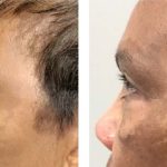 Photo of Face/Neck Lift