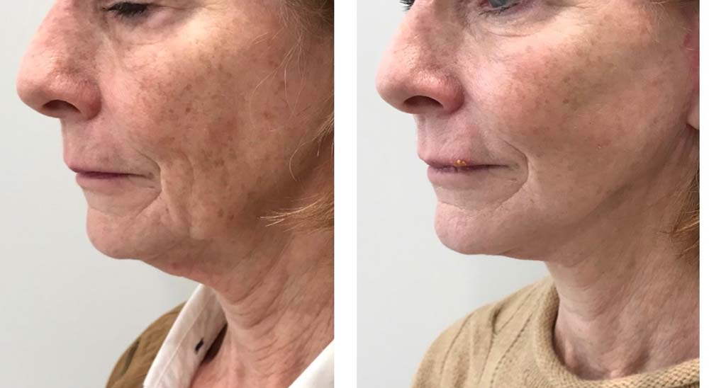 Photo of Face/Neck Lift