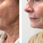 Photo of Face/Neck Lift