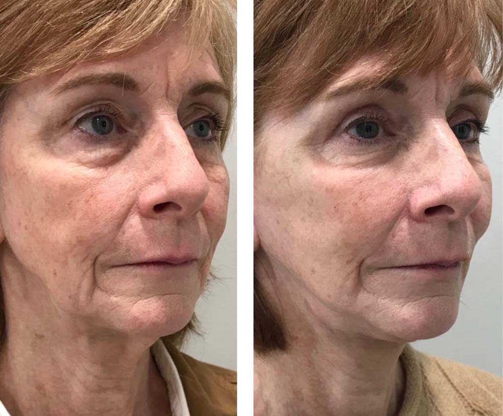 Photo of Face/Neck Lift