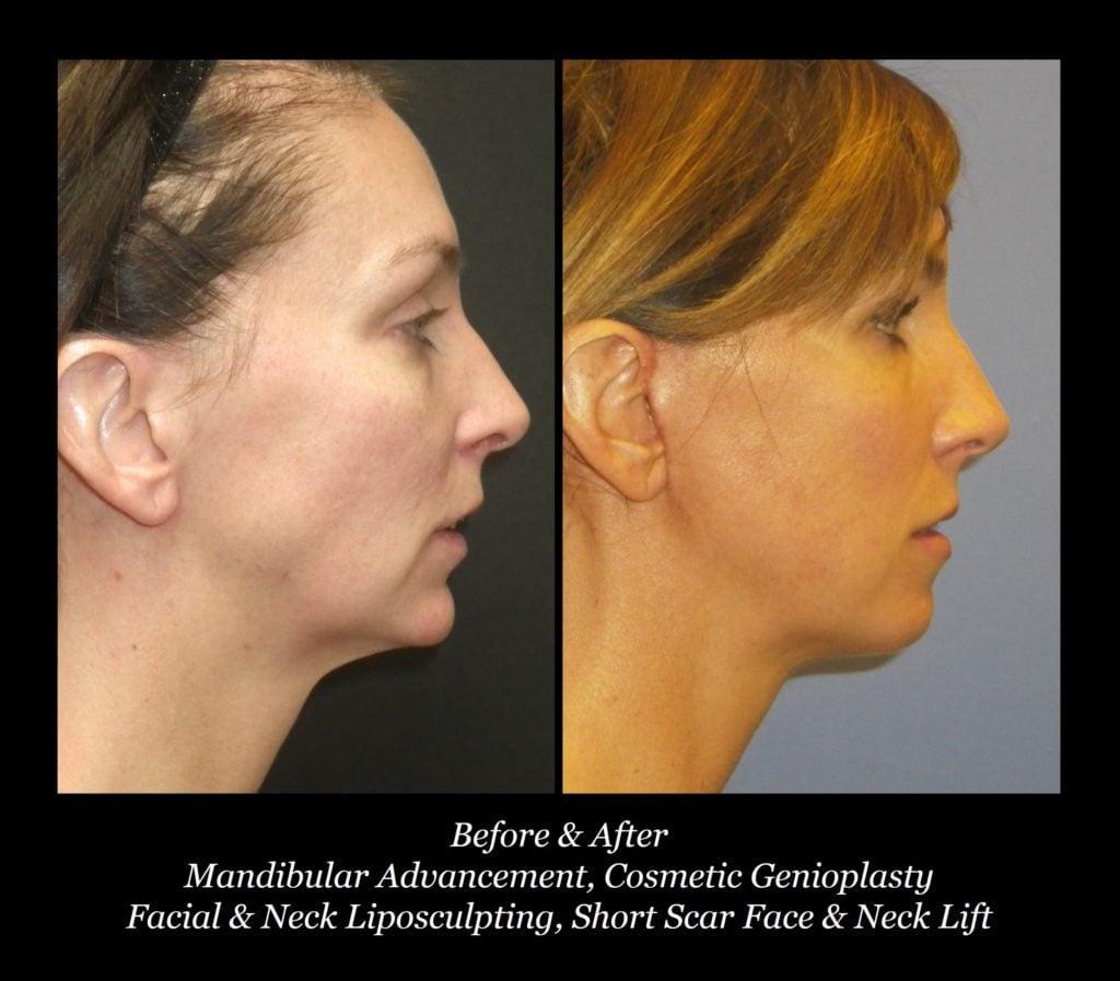 Photo of Face/Neck Lift