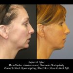 Photo of Face/Neck Lift