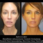 Photo of Face/Neck Lift