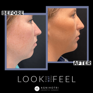 Facial Implants before and after