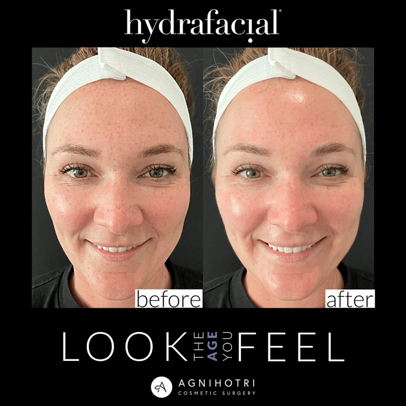 Hydrafacial before and after