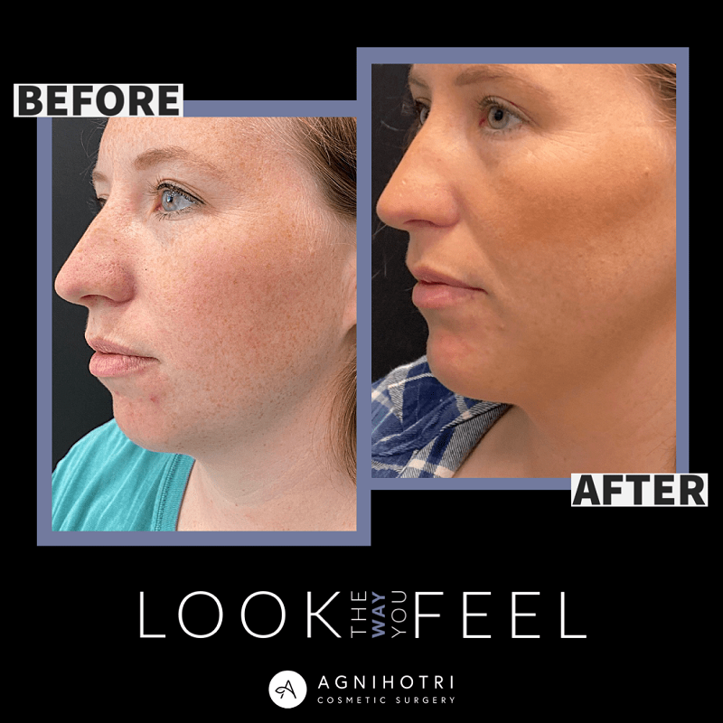Facial Implants before and after