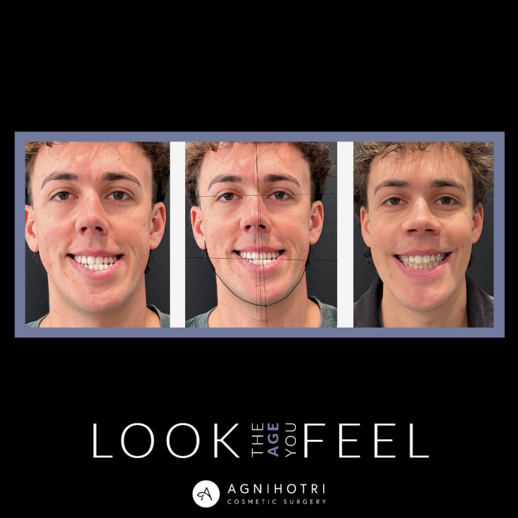 Photo of Jaw Surgery