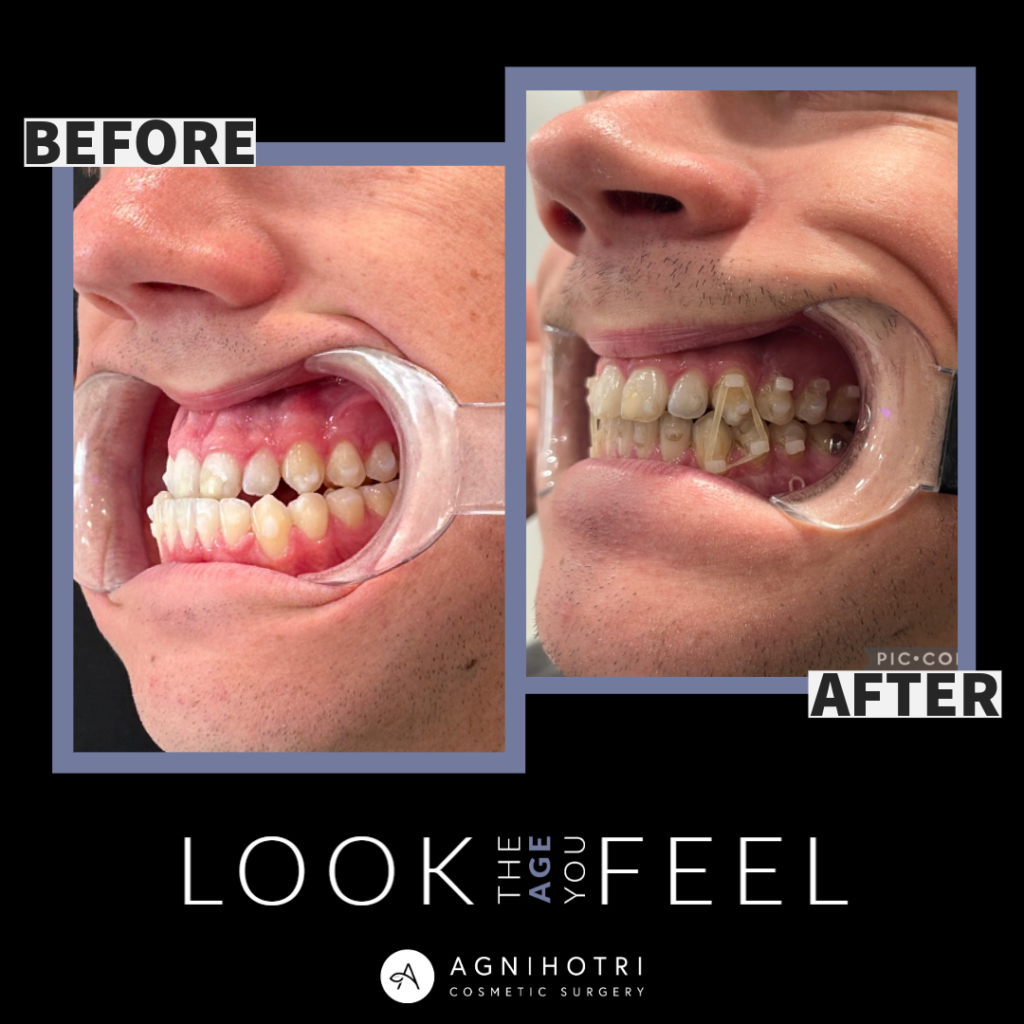 Photo of Jaw Surgery