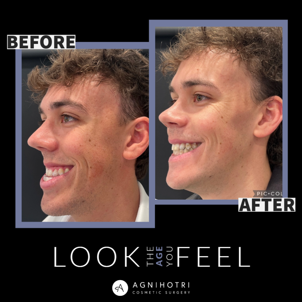 Photo of Jaw Surgery