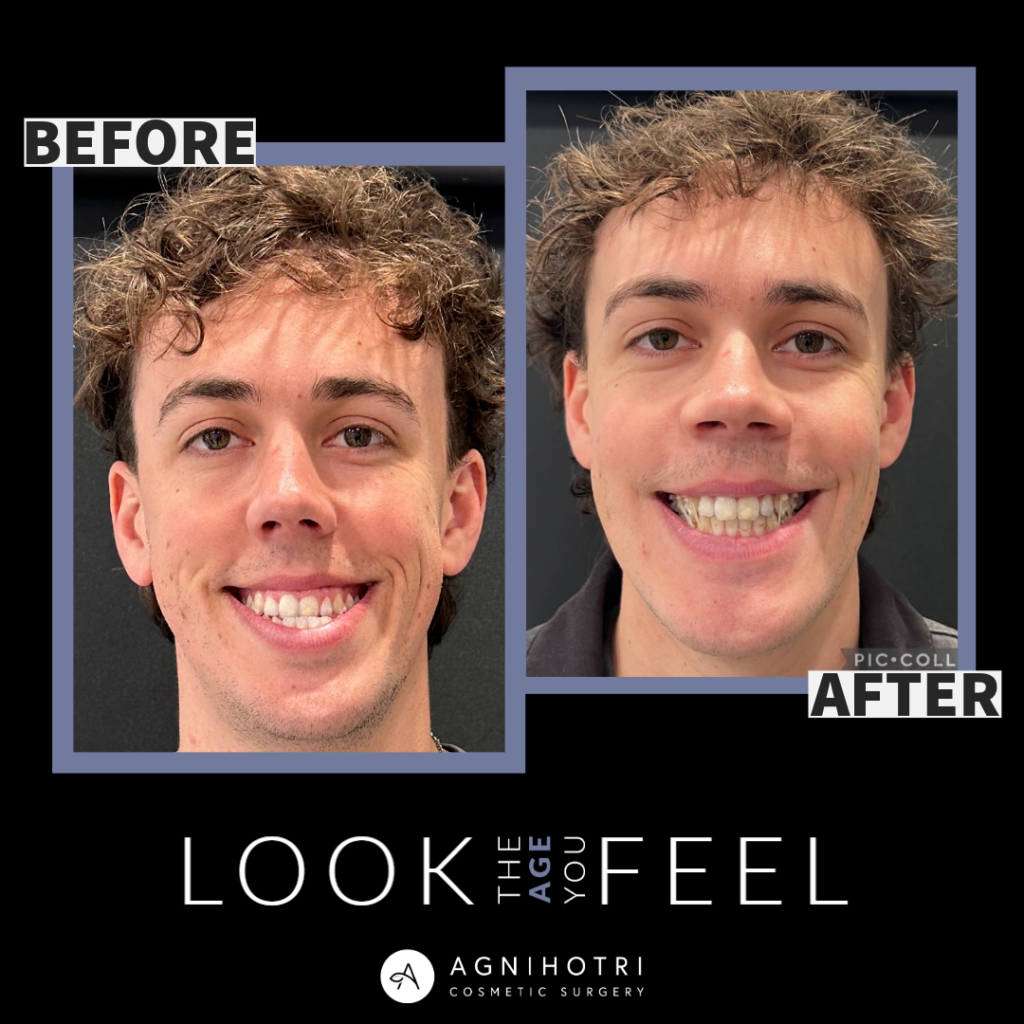 Photo of Jaw Surgery
