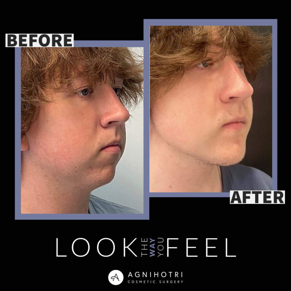 Photo of Jaw Surgery