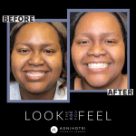 Photo of Jaw Surgery