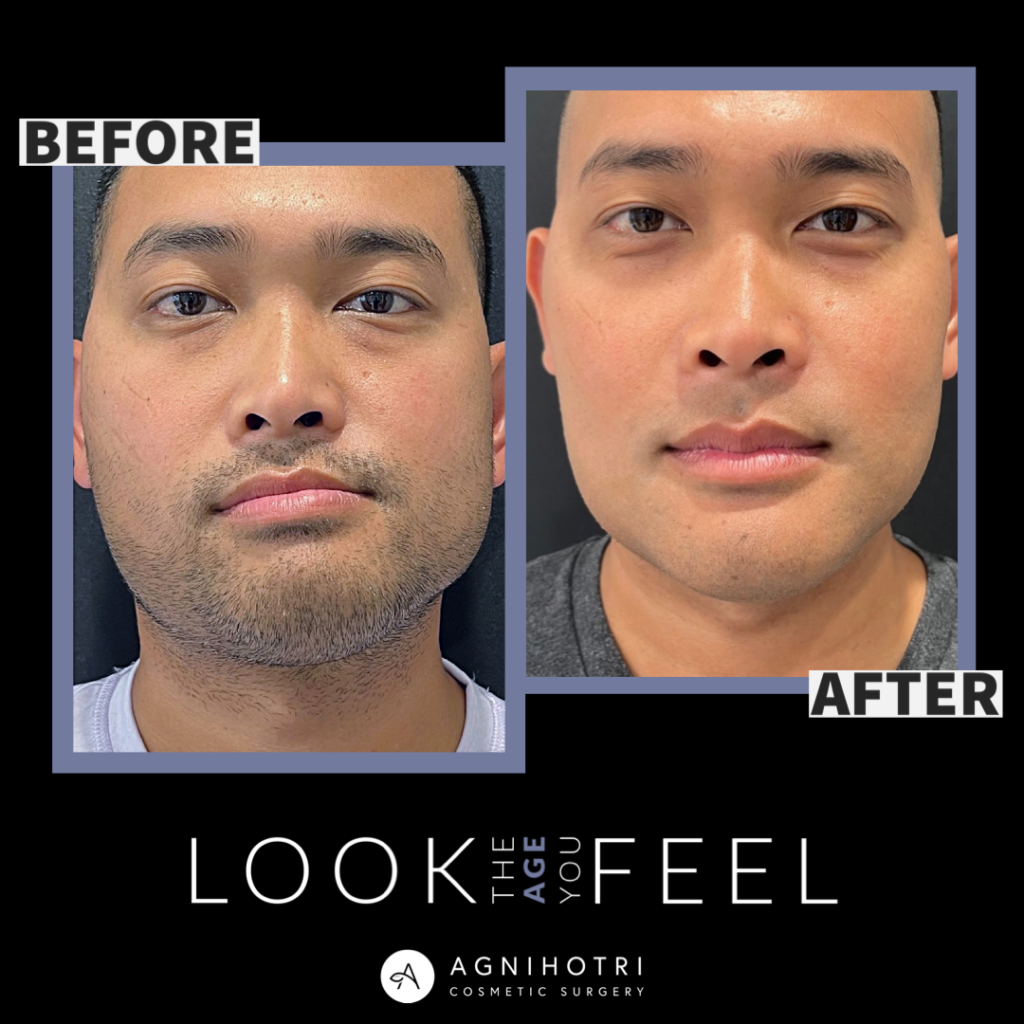 Photo of Jaw Surgery