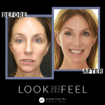 Photo of Jaw Surgery