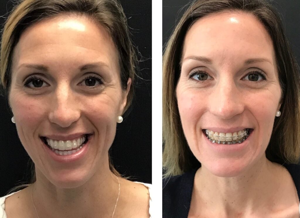Photo of Jaw Surgery