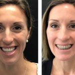Photo of Jaw Surgery